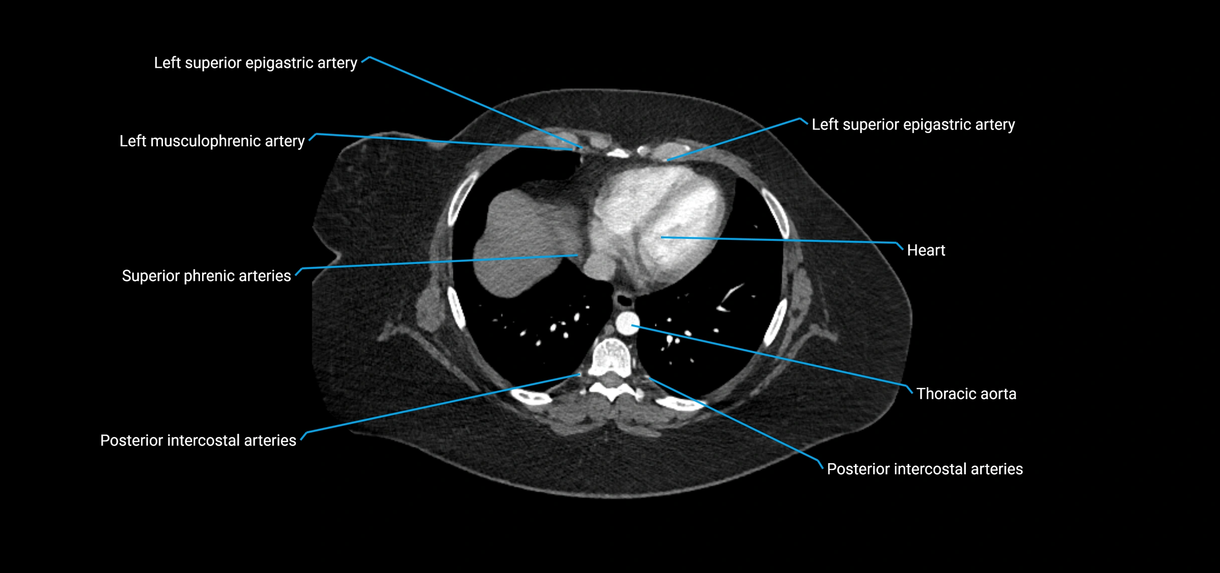 CTA abdomen axial cross sectional anatomy labelled image_8 (1).webp